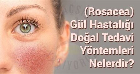 Rosacea (Gül Hastalığı) Tedavi Yöntemleri